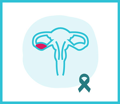 Ovarian Cancer